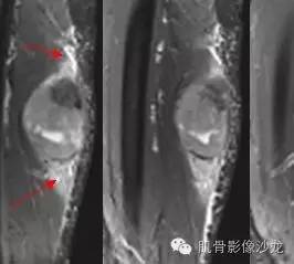 【病例】横纹肌肉瘤2例MR病例讨论 【病例】横纹肌肉瘤2例MR病例讨论