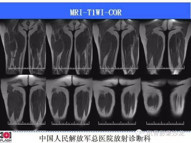 【病例】横纹肌肉瘤2例MR病例讨论 【病例】横纹肌肉瘤2例MR病例讨论