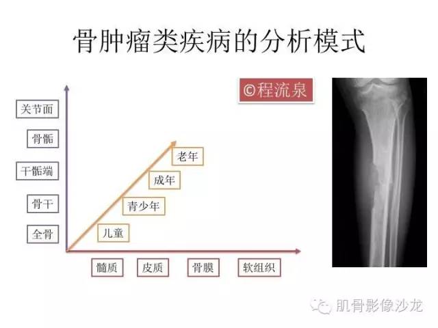 【病例】横纹肌肉瘤2例MR病例讨论 【病例】横纹肌肉瘤2例MR病例讨论