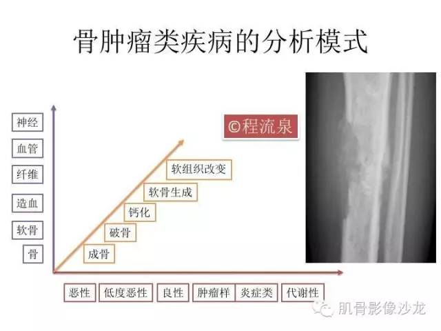 【病例】横纹肌肉瘤2例MR病例讨论