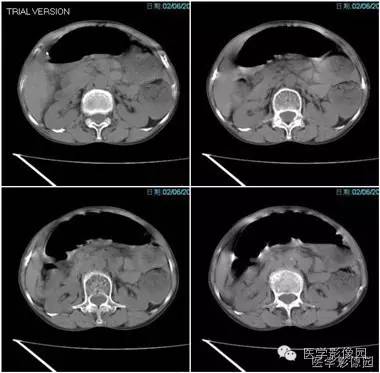 【病例】乙状结肠扭转1例CT影像表现