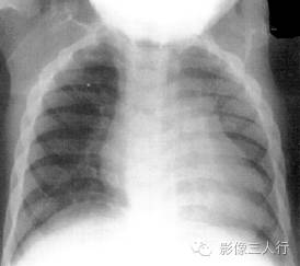 "船桨征"，这个征象提示啥？