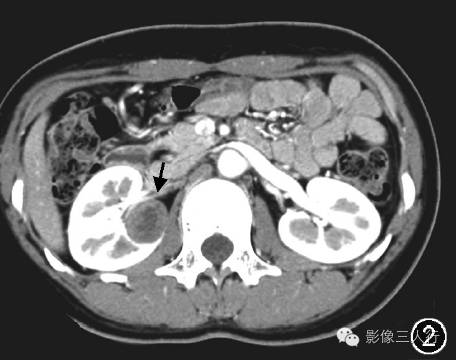 肾球旁细胞瘤的CT、MRI表现及临床特征分析