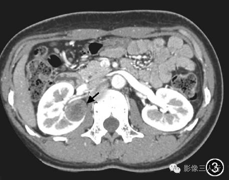 肾球旁细胞瘤的CT、MRI表现及临床特征分析