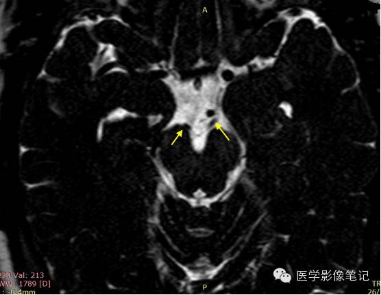 12对脑神经记忆口诀及影像解剖 12对脑神经记忆口诀及影像解剖