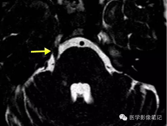 12对脑神经记忆口诀及影像解剖 12对脑神经记忆口诀及影像解剖