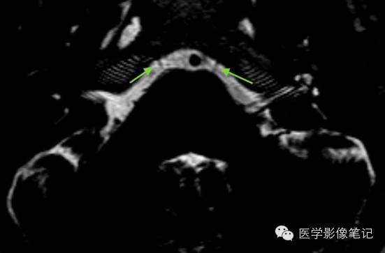 12对脑神经记忆口诀及影像解剖 12对脑神经记忆口诀及影像解剖