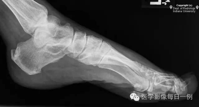 【病例】第一趾骨骨髓炎1例X线影像表现 【病例】第一趾骨骨髓炎1例X线影像表现