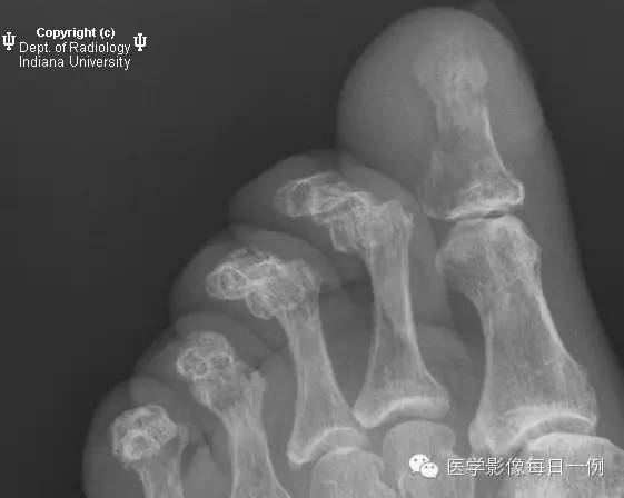 【病例】第一趾骨骨髓炎1例X线影像表现