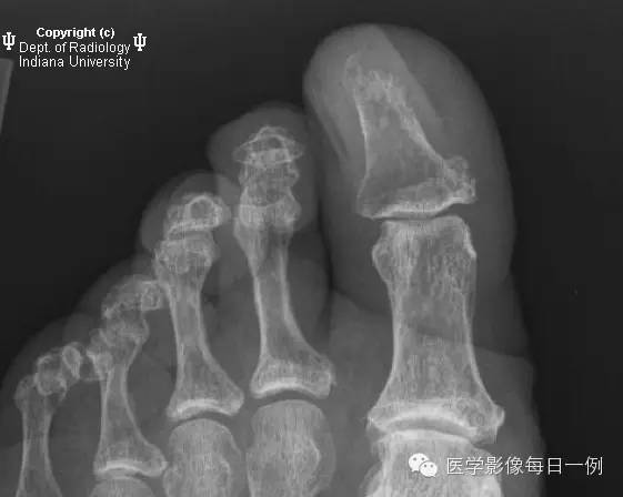 【病例】第一趾骨骨髓炎1例X线影像表现 【病例】第一趾骨骨髓炎1例X线影像表现