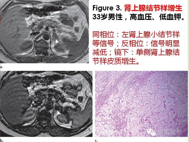 【PPT】成人肾上腺肿瘤及肿瘤样病变影像与病理相关性