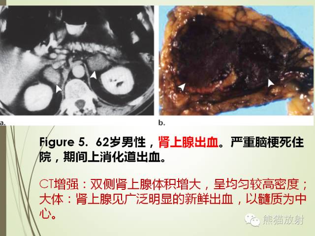 【PPT】成人肾上腺肿瘤及肿瘤样病变影像与病理相关性