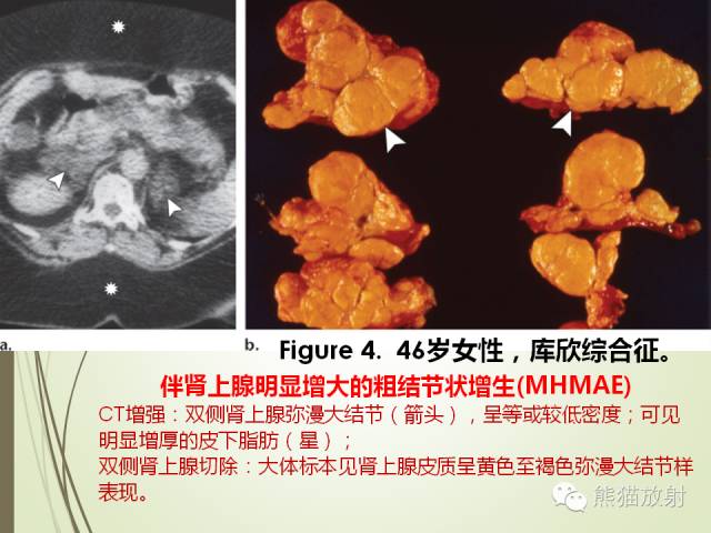 【PPT】成人肾上腺肿瘤及肿瘤样病变影像与病理相关性