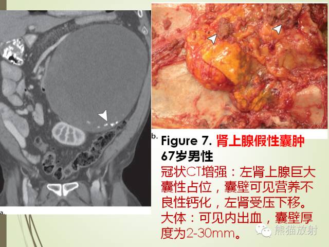 【PPT】成人肾上腺肿瘤及肿瘤样病变影像与病理相关性