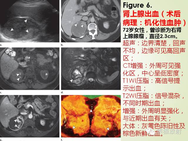 【PPT】成人肾上腺肿瘤及肿瘤样病变影像与病理相关性