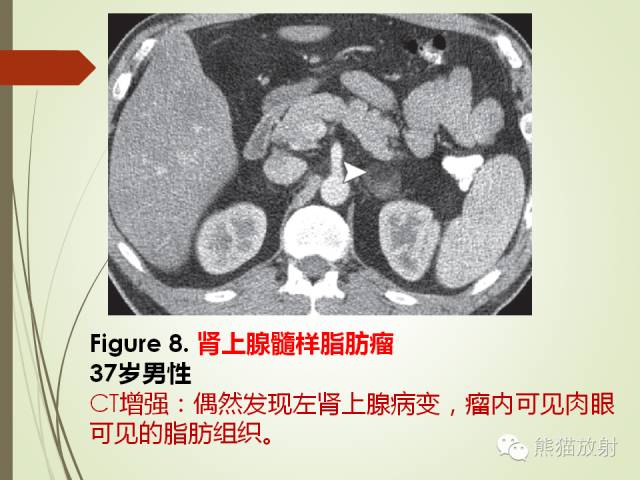【PPT】成人肾上腺肿瘤及肿瘤样病变影像与病理相关性