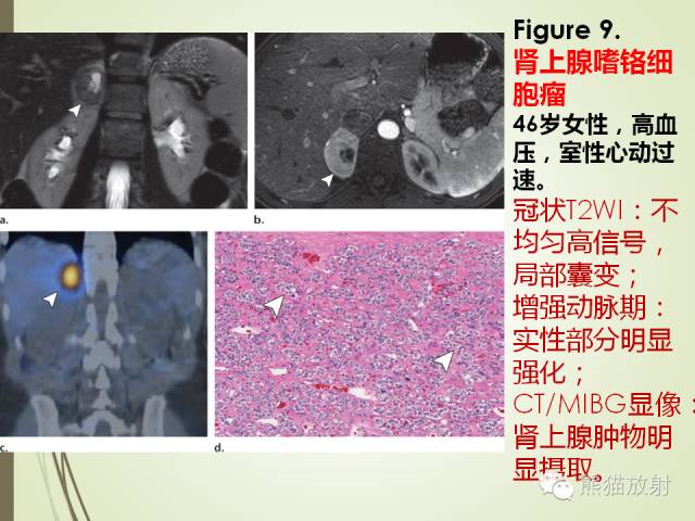 【PPT】成人肾上腺肿瘤及肿瘤样病变影像与病理相关性