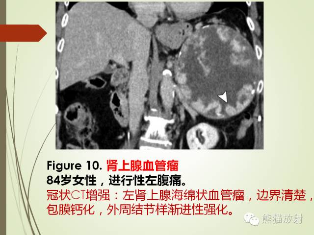 【PPT】成人肾上腺肿瘤及肿瘤样病变影像与病理相关性