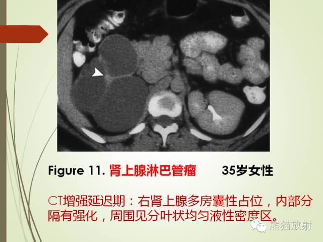 【PPT】成人肾上腺肿瘤及肿瘤样病变影像与病理相关性