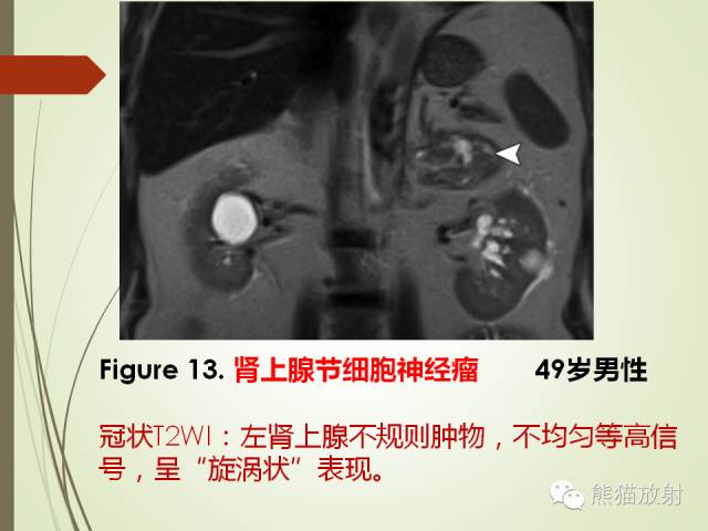 【PPT】成人肾上腺肿瘤及肿瘤样病变影像与病理相关性