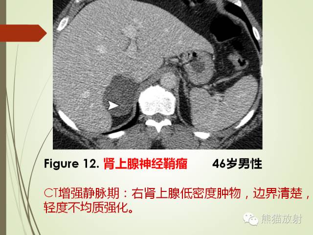 【PPT】成人肾上腺肿瘤及肿瘤样病变影像与病理相关性