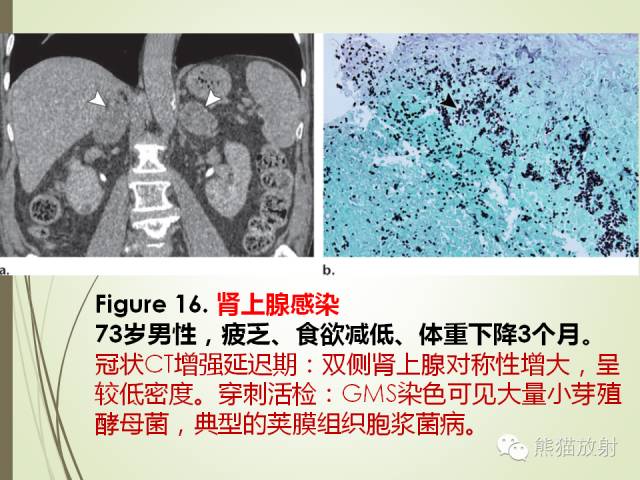 【PPT】成人肾上腺肿瘤及肿瘤样病变影像与病理相关性