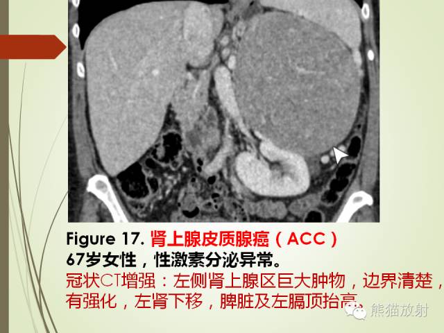 【PPT】成人肾上腺肿瘤及肿瘤样病变影像与病理相关性