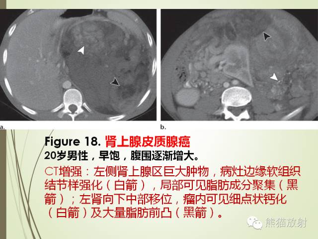 【PPT】成人肾上腺肿瘤及肿瘤样病变影像与病理相关性