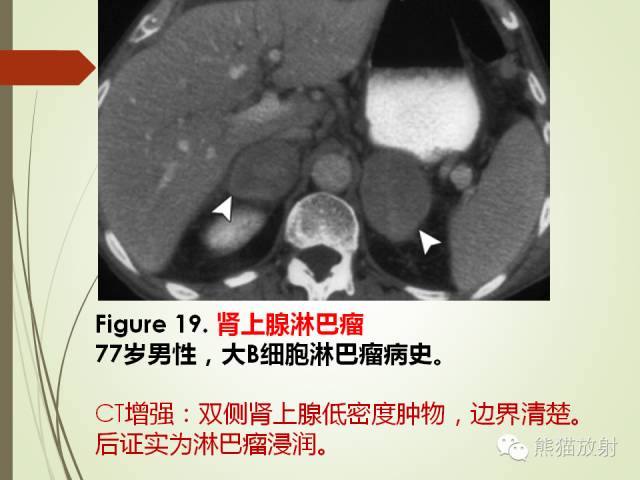 【PPT】成人肾上腺肿瘤及肿瘤样病变影像与病理相关性
