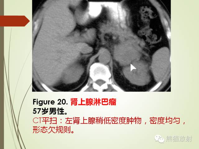 【PPT】成人肾上腺肿瘤及肿瘤样病变影像与病理相关性