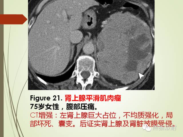 【PPT】成人肾上腺肿瘤及肿瘤样病变影像与病理相关性