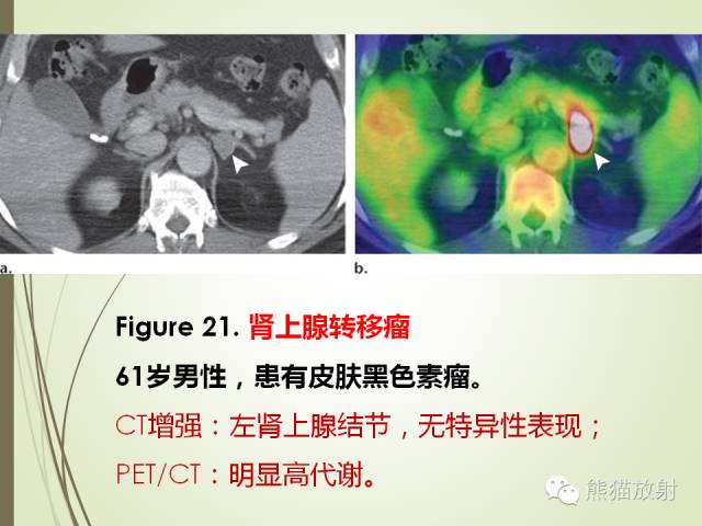 【PPT】成人肾上腺肿瘤及肿瘤样病变影像与病理相关性