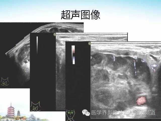 【病例】甲状腺未分化肉瘤1例CT影像表现