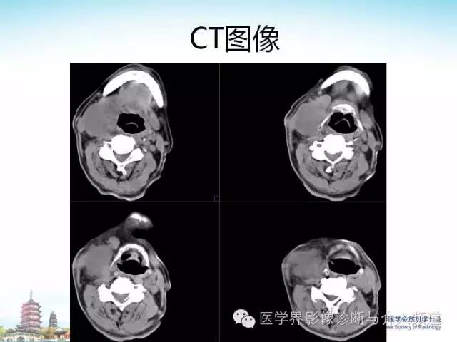 【病例】甲状腺未分化肉瘤1例CT影像表现