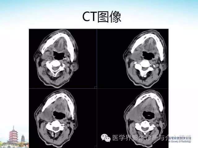 【病例】甲状腺未分化肉瘤1例CT影像表现