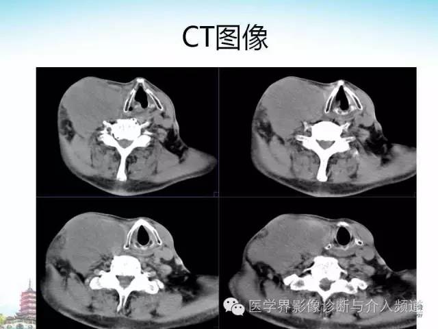 【病例】甲状腺未分化肉瘤1例CT影像表现