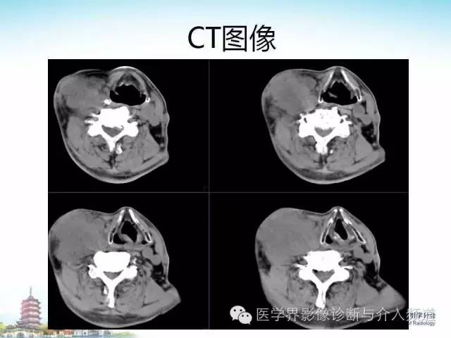 【病例】甲状腺未分化肉瘤1例CT影像表现