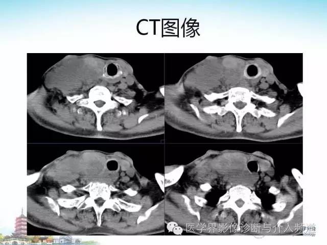 【病例】甲状腺未分化肉瘤1例CT影像表现