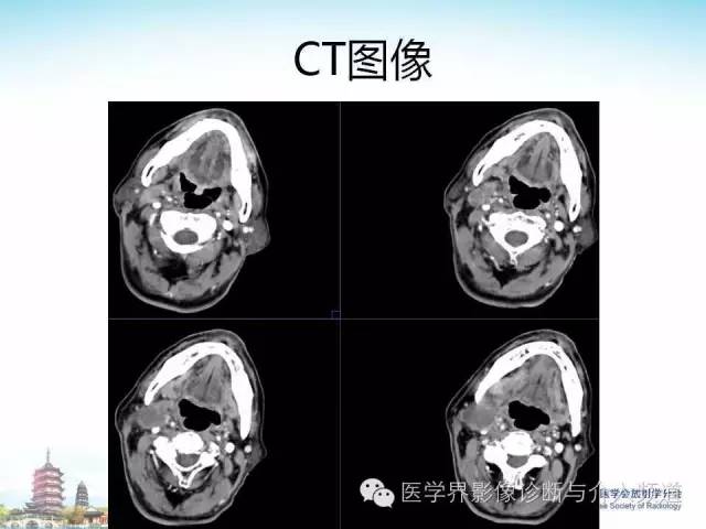 【病例】甲状腺未分化肉瘤1例CT影像表现
