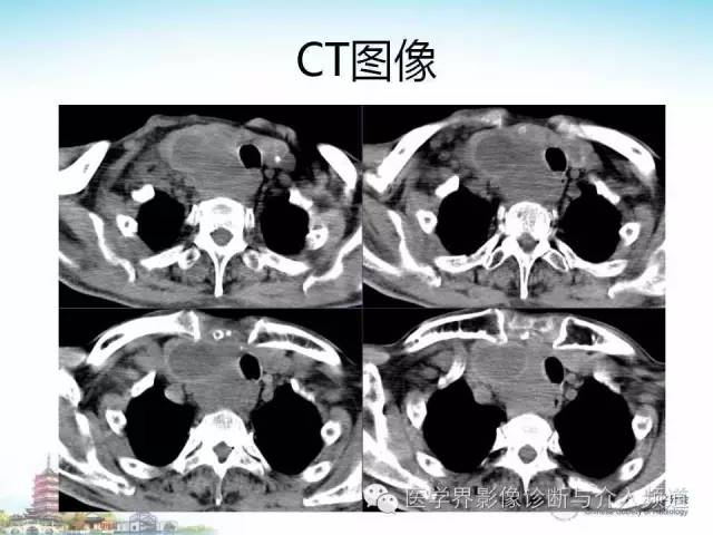 【病例】甲状腺未分化肉瘤1例CT影像表现
