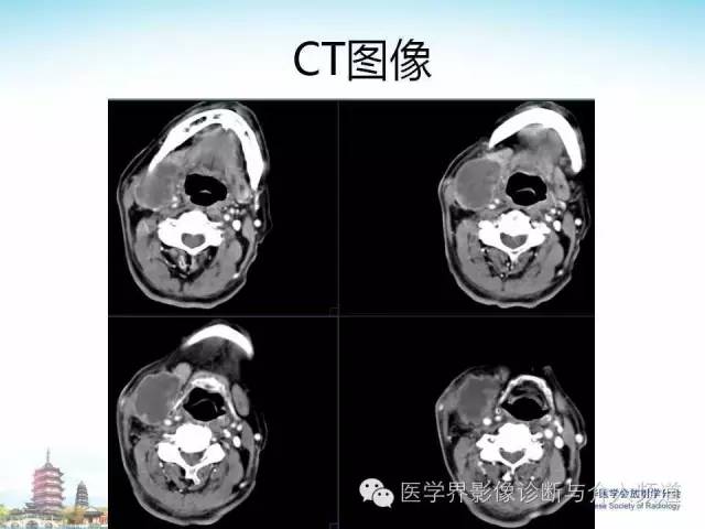 【病例】甲状腺未分化肉瘤1例CT影像表现