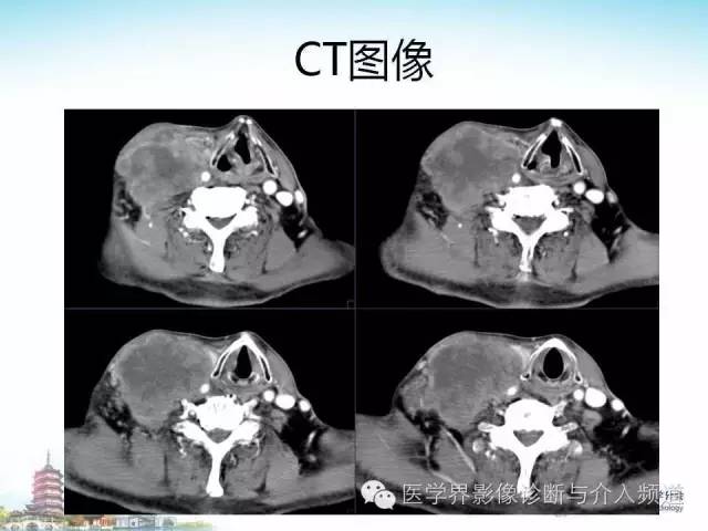 【病例】甲状腺未分化肉瘤1例CT影像表现