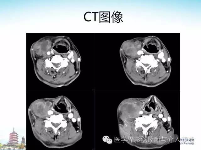 【病例】甲状腺未分化肉瘤1例CT影像表现
