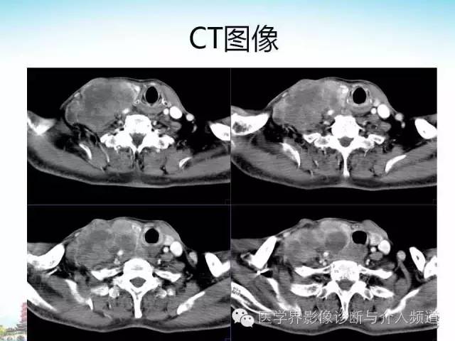 【病例】甲状腺未分化肉瘤1例CT影像表现