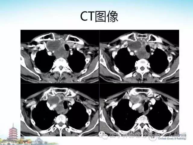 【病例】甲状腺未分化肉瘤1例CT影像表现