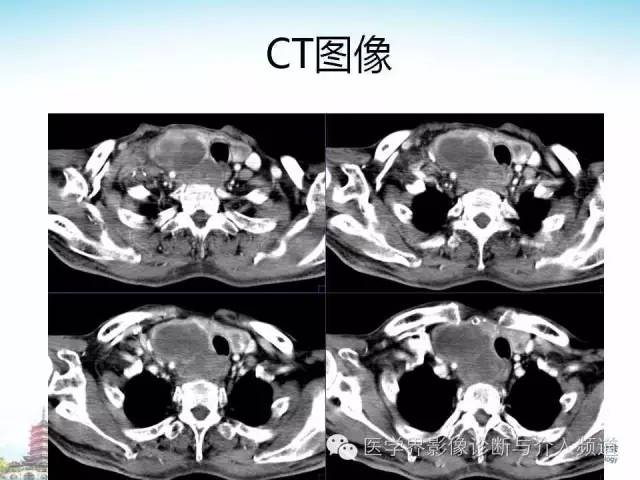 【病例】甲状腺未分化肉瘤1例CT影像表现