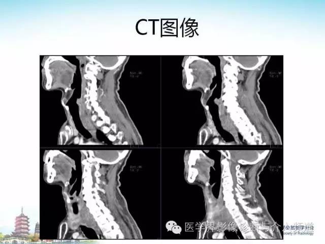 【病例】甲状腺未分化肉瘤1例CT影像表现