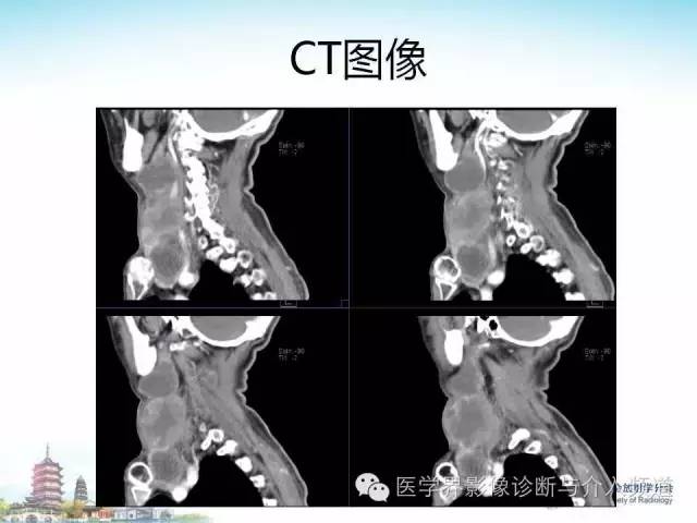 【病例】甲状腺未分化肉瘤1例CT影像表现