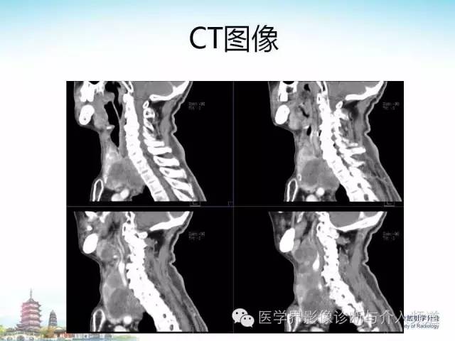 【病例】甲状腺未分化肉瘤1例CT影像表现