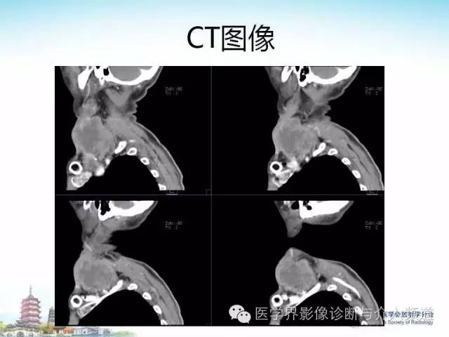 【病例】甲状腺未分化肉瘤1例CT影像表现